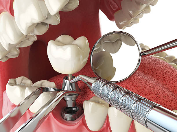 Best Broken Tooth Emergency  in Kirkland, WA